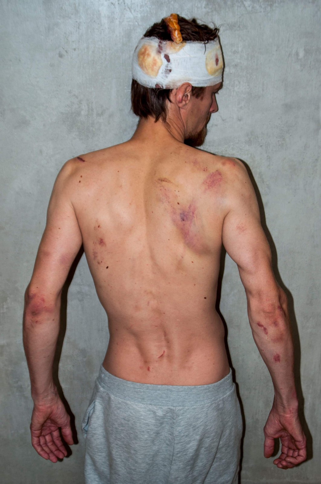 Как брат Дарьи Домрачевой выглядит после избиения минским ОМОНом (фото 18+)