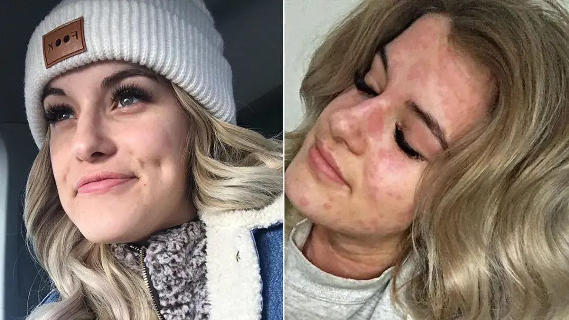 Аллергия на холод: симптомы и лечение