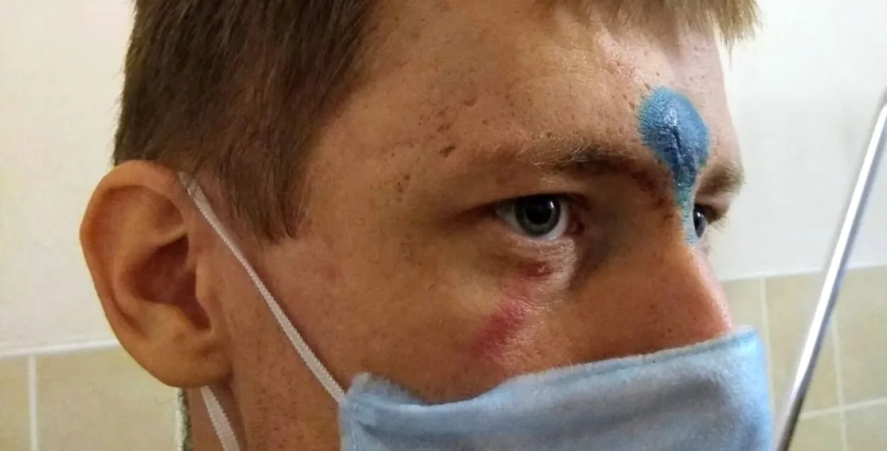 Андрей Вербицкий, раненый в Могилёве / svaboda.org​