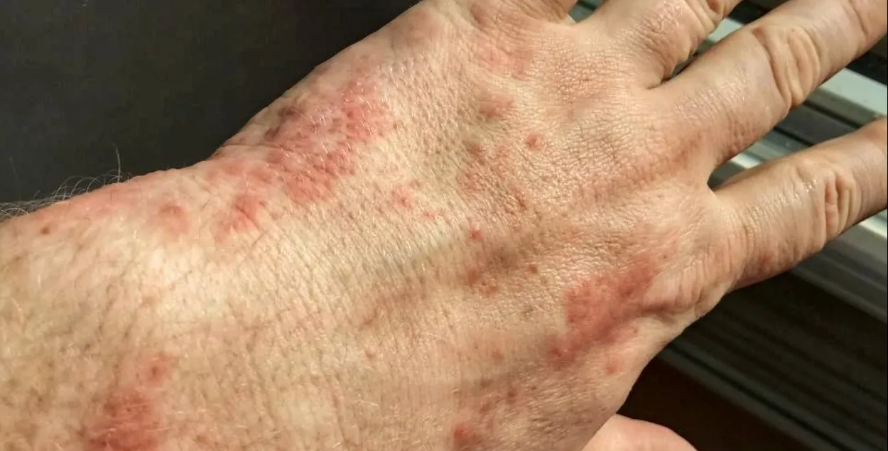 Руки белоруса после камеры с клопами
