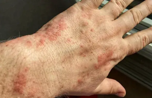 Руки белоруса после камеры с клопами
