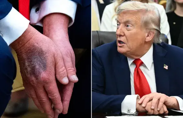 Сінякі на руках Трампа непакояць дактароў
